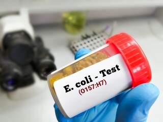 Stool sample for E. coli O157:H7 test. Serotype of Escherichia coli bacteria.