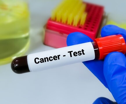 Blood sample in Doctor hand for Cancer test, cancer marker test.
