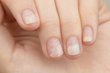 Fingernails with onycholysis after removing gel polish. Womans hands with damaged nails - obrazy, fototapety, plakaty