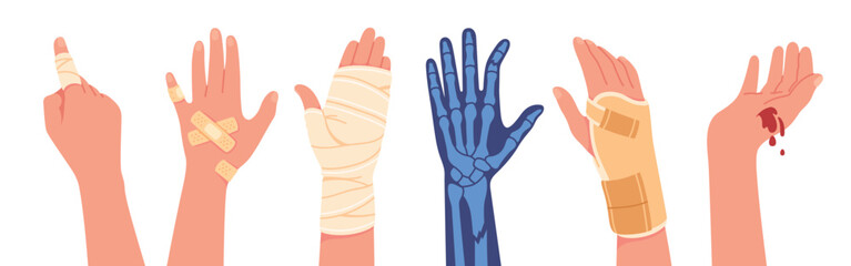 Hand injury treatment set. Injured human hands with bandage, brace, bleeding finger cut medical aid, x-ray collection. Wound pain, medicine, health care, accident trauma flat vector illustration - obrazy, fototapety, plakaty