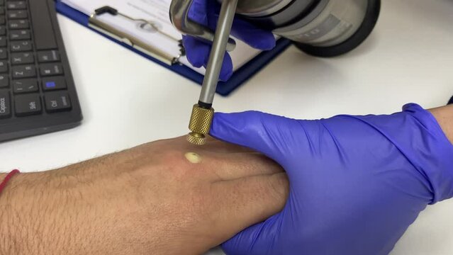 Cryotherapy. Freezing and removal of warts with liquid nitrogen