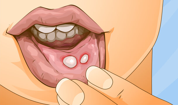 Oral disease. Stomatitis. Close-up illustrtion. Healthcare illustration. Vector illustration.