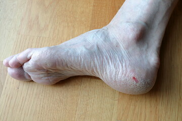 Small injury. Old rough skin at a feet.