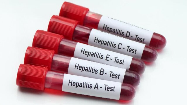 Hepatitis test to look for abnormalities from blood, scientific experiment