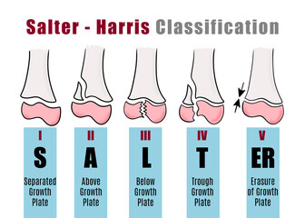 Salter - Harris classification to to recognize and identify different types of bone fractures