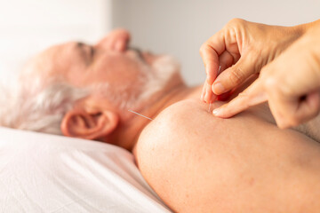 The hands of a physiotherapist place needles on the shoulder of an older man, during an acupuncture...