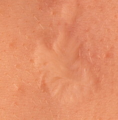 Fototapeta premium Scar on human skin after heart surgery