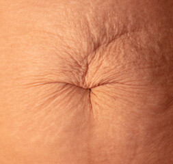 Stretch marks on the abdomen after childbirth. Close-up