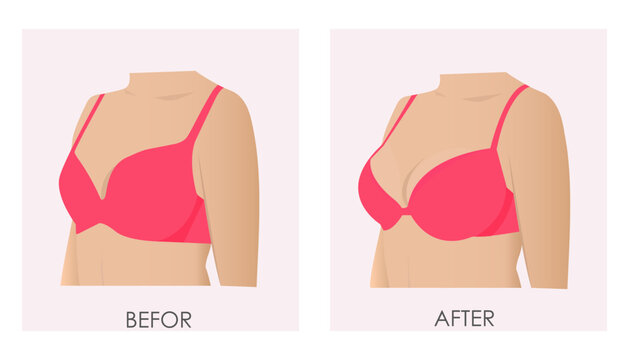 Vector illustration of a woman's breasts before and after enlargement in cartoon style. Female breasts in a pink bra. Plastic surgery for breast augmentation.