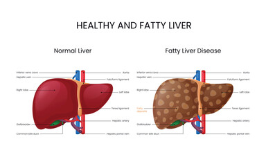 Normal Liver And Fatty Liver Disease - obrazy, fototapety, plakaty