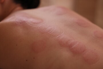 Closeup view of woman after cupping therapy indoors