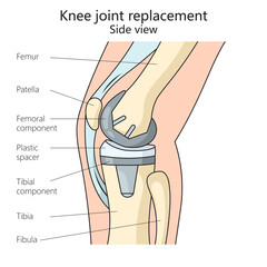 knee joint replacement structure diagram hand drawn schematic raster illustration. Medical science educational illustration - obrazy, fototapety, plakaty