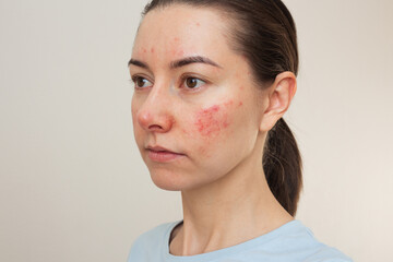young Caucasian woman suffering from rosacea on her face in the acute stage. Dermatological...
