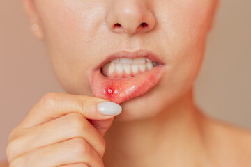 a close-up of the face of a young woman who turns her lip with her finger shows an ulcer of...