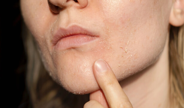 The woman skin flakes off at the mouth. Dry skin. Face skin irritation after peeling, after cold windy weather. Dark background, view by profile