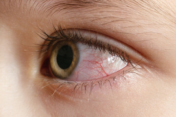 Closeup irritated infected red bloodshot eyes, conjunctivitis