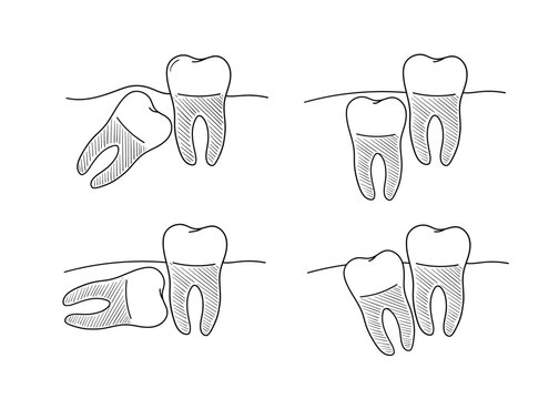Dental anatomy set, incorrect teeth growth, set of vector illustrations in doodle style