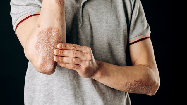 Acute psoriasis on the elbows is an autoimmune incurable dermatological skin disease. A large red, inflamed, flaky rash on the elbows. Joints affected by psoriatic arthritis