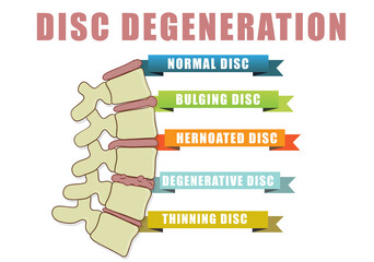Disc degeneration diagram with condition exampes - bulging, hernoated, degenerative and thinning disc. Educational medical information. Illustration