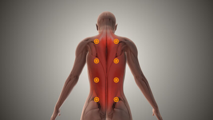 Myofascial pain syndrome or chronic pain disorder - obrazy, fototapety, plakaty