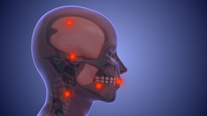 Referred pain from muscle trigger points in the masticatory and neck-shoulder musculature