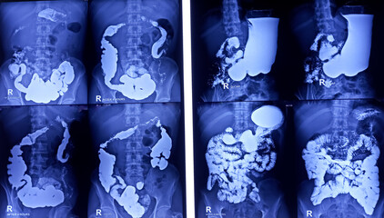 Barium meal and follow through examination x-ray. showing digestive system. most part of stomach, large intestine such as transverse colon, sigmoid colon and rectum. Normal findings.