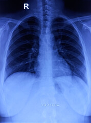 CXR (Chest X-Ray) PA view. Cervical ribs, normal findings.