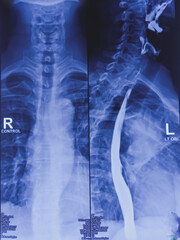 Barium swallow of oesophagus examination x-ray. showing upper digestive system. Oesophagus, mucosal...