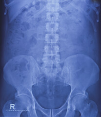 X-ray of KUB region. Bowel gas and fecal matter. Normal finding.