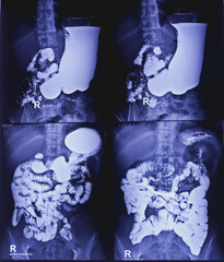 Barium swallow of oesophagus examination x-ray. showing upper digestive system. Oesophagus, mucosal pattern of oesophagus, Normal findings.