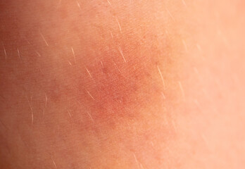 Close-up of a bruise on the skin. Macro