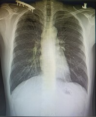 X-ray body bone medical