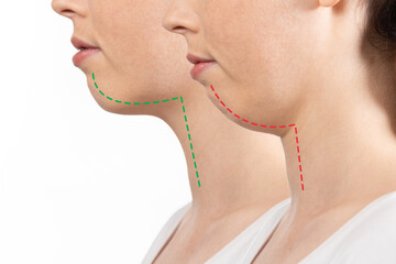 Overbite dental occlusion. Woman's face before and after correction of malocclusion of teeth...