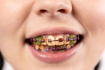 Close up of young Caucasian smiling woman with brackets on dirty yellow teeth with parsley leaves....