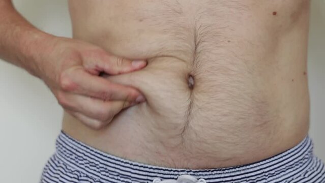 Cropped photo of male stomach with overweight. Unrecognisable man with fat hairy naked abdomen shakes with hands fat folds. Excess belly fat, unhealthy lifestyle, diet. Overweight problem concept