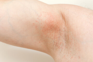Fototapeta premium Allergy underarm. Cropped photo of irritation, inflammation on the sensitive skin after using a razor, trimmer, toxic deodorant or antiperspirant. Armpit rash. Atopic dermatitis. Acne or red spots.
