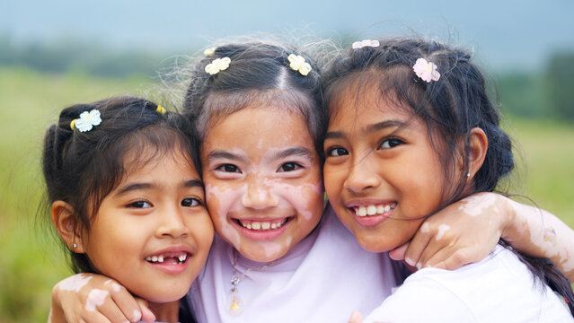 Little cute alpha young albino vitiligo small girl group smile look at camera fun joy hug in meadow field. Melanin face body of asia people gen z kid self love happy diverse of beauty skin care color.