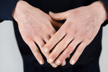 Fototapeta premium Men's hands with dry damaged skin from wind and frost, the man is frozen, the skin is cracking, hand skin care is needed