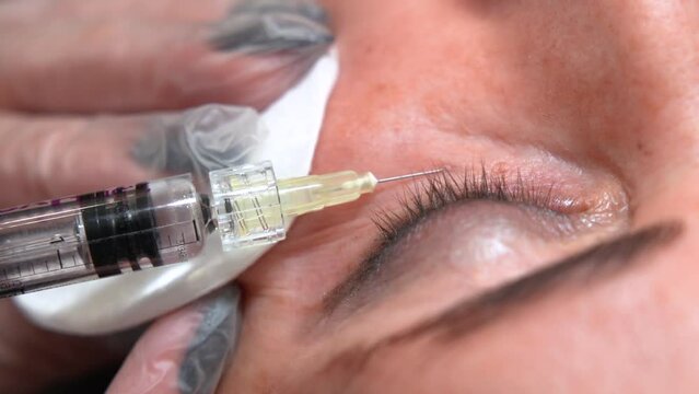 Cosmetologist doctor making multiple injections biorevitalization in woman face skin under eye, closeup shot. Mesotherapy, beauty concept