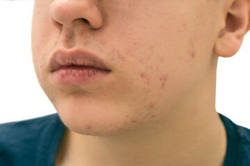 Close-up of the skin with acne of a teenage guy.