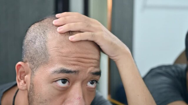Asian man having stress about his hair loss problem.