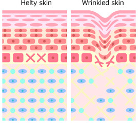健康な肌としわのある肌の断面図