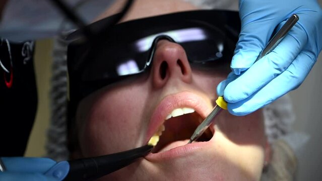 Dental Whitening process in patient mouth. Teeth whitening with UF Lamp, Led Lamp and gel. Dental Extreme Close up Macro Video. Concept of professional dental hygiene. 4k 120 fps slow motion footage