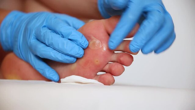 A doctor examines the foot of a person who has a large callus and a stem wart. Treatment and removal of warts and corns, close-up