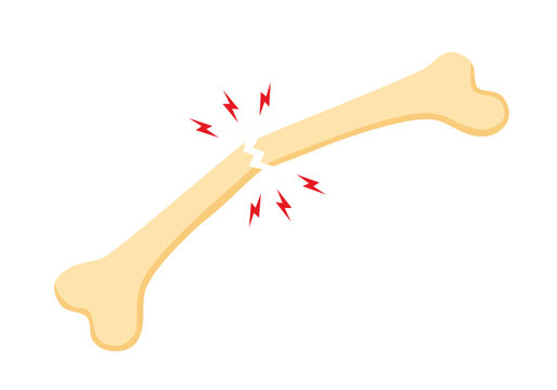 Broken human bone in flat design on white background.