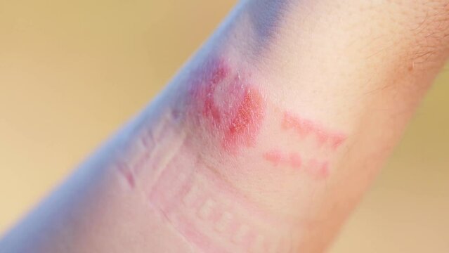 Irritation, redness and itching on the skin after wearing a watch or fitness bracelet. Allergy to watch strap, contact dermatitis, close-up