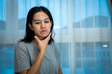 Fototapeta premium Acne on face because the disorders of sebaceous glands productions. Acne or a Cosmetic Allergy. Hormonal changes and Foods Cause Symptoms of Skin Allergies