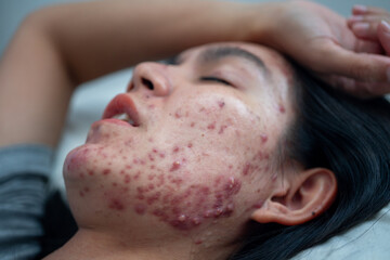 Acne on face because the disorders of sebaceous glands productions.  Acne or a Cosmetic Allergy. Hormonal changes and Foods Cause Symptoms of Skin Allergies