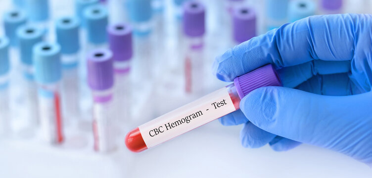 Doctor holding a test blood sample tube with CBC hemogram test on the background of medical test tubes with analyzes