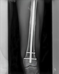 X-ray image of the femur with an intramedullary (IM) nail showcases a surgical intervention to...